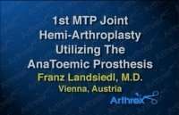 1st MTP Joint Hemi-Arthroplasty utilizing the AnaToemic Prosthes