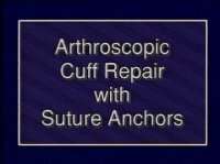 Arthroscopic Rotator Cuff Repair with Corkscrew Suture Anchor