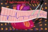 Understanding EKGs
