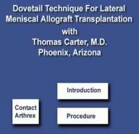 Dovetail Technique for Lateral Meniscal Allograft Transplantatio