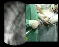 Endoscopic stenting Эндоскопическое стентирование