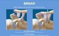 Minimaly INvasive Acromioclavicular joint Reconstruction
