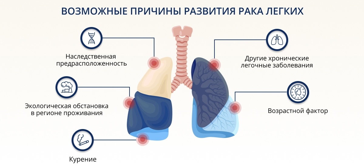 Рак легкого: что надо знать об одном из самых распространенных онкологических заболеваний