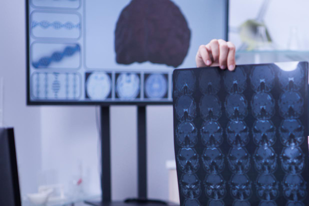 В США одобрили еще один препарат от болезни Альцгеймера от Biogen В США одобрили еще один препарат от болезни Альцгеймера от Biogen