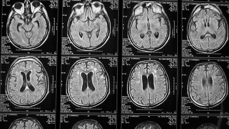 Ученые впервые доставили лекарства в мозг с помощью ультразвука Ученые впервые доставили лекарства в мозг с помощью ультразвука